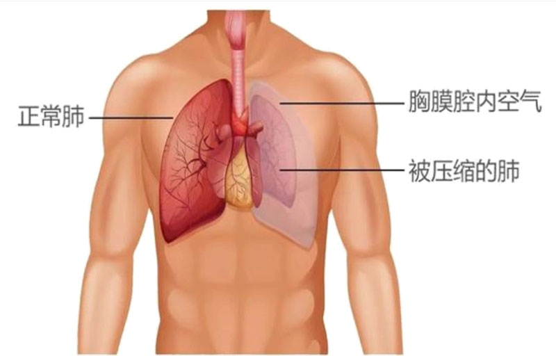 什么是气胸？